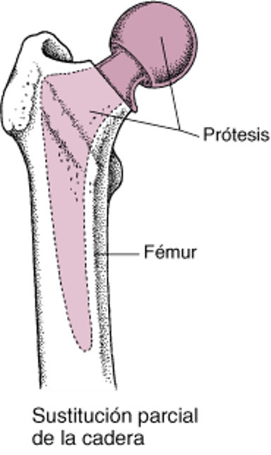 Sustitución de cadera