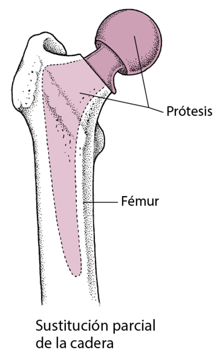 Sustitución de cadera