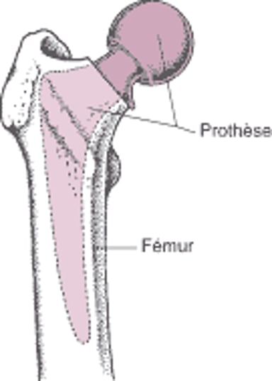 Remplacement de la hanche