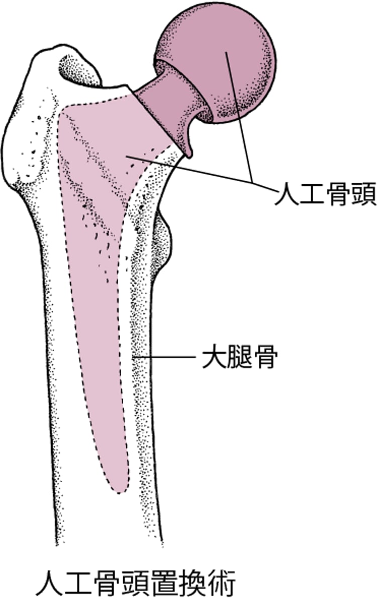 股関節の置換手術