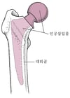 고관절 치환