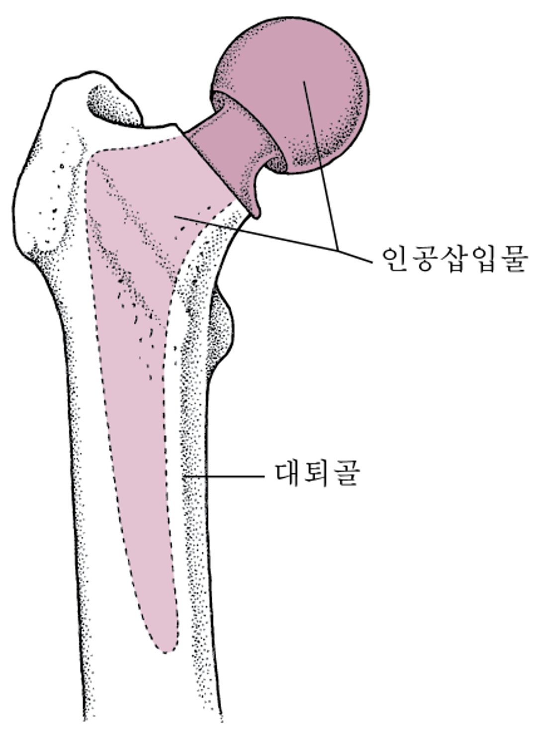 고관절 치환