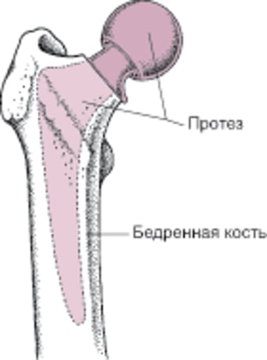 Полная замена тазобедренного сустава