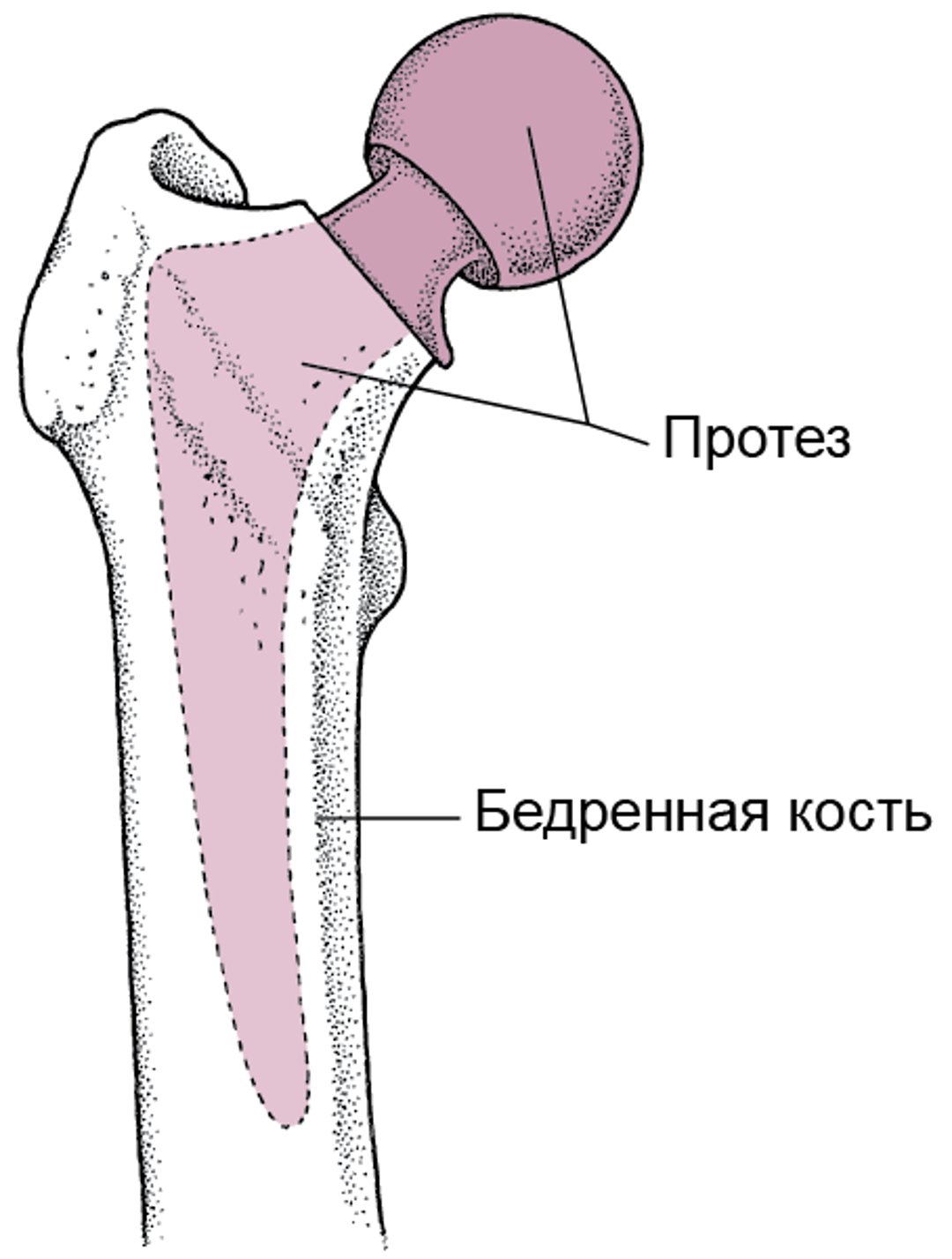 Полная замена тазобедренного сустава