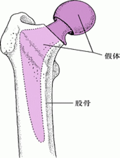 髋关节置换