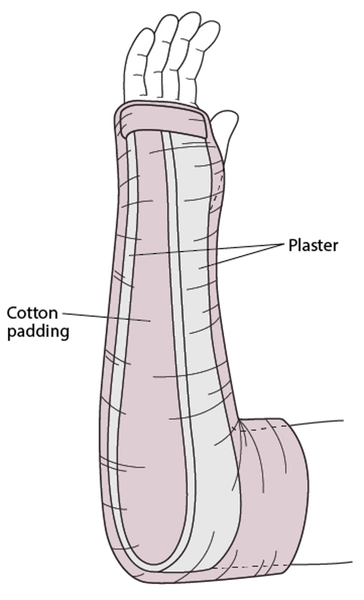 Sugar Tong Splint