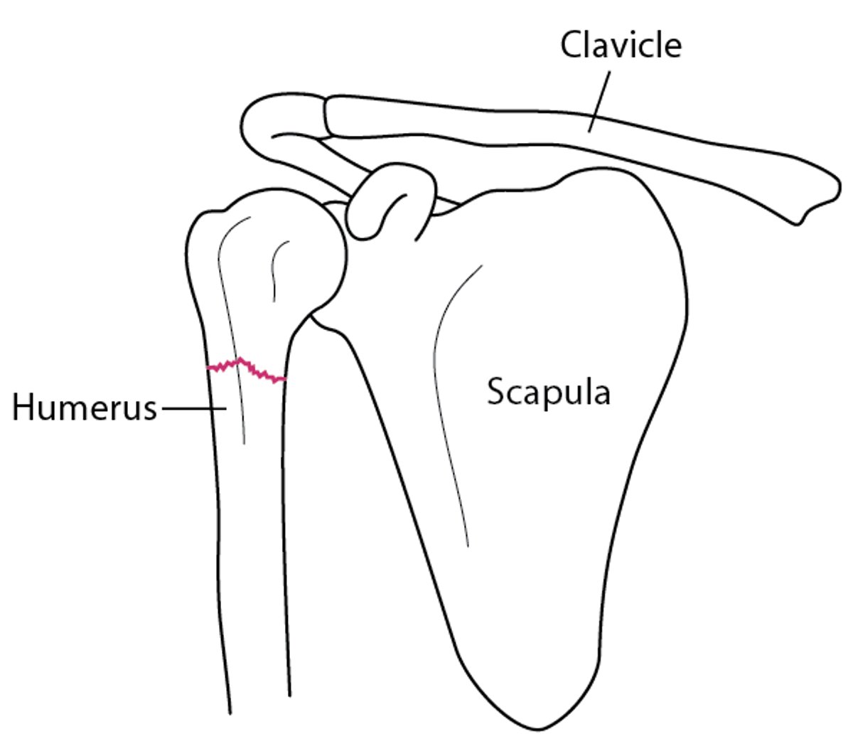 Shoulder Fracture