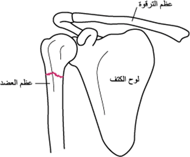 كسر الكتف
