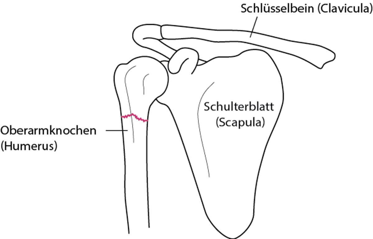 Schulterfraktur