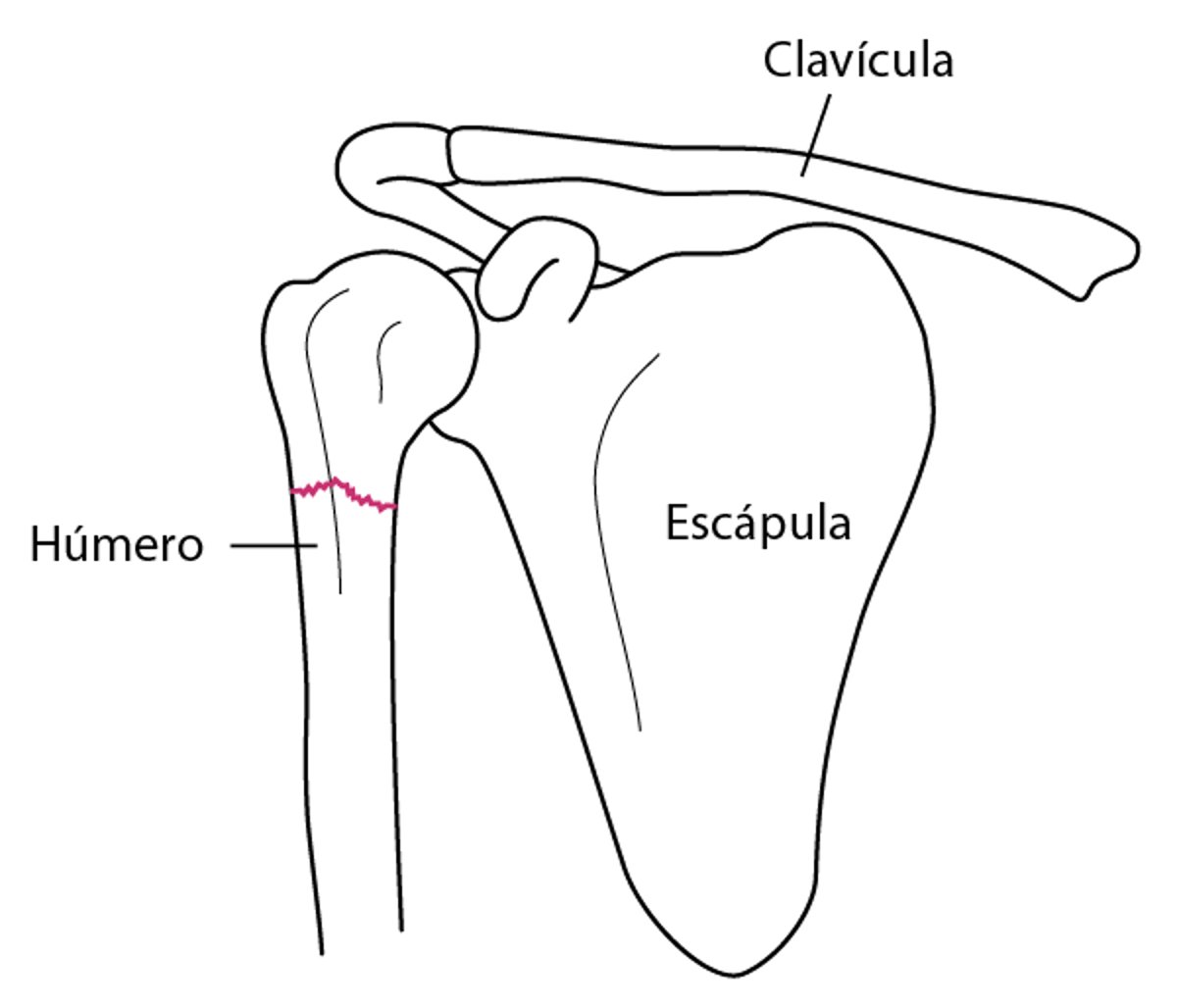 Fractura del hombro