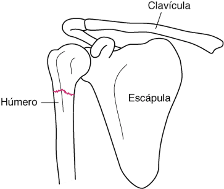 Fractura del hombro