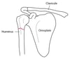 Fracture de l’épaule