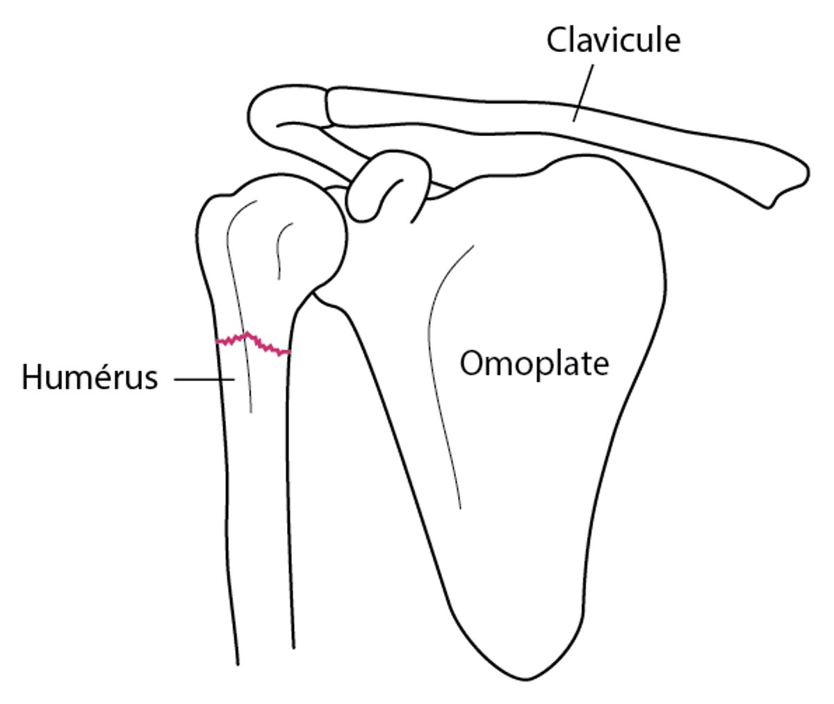 Fracture de l’épaule