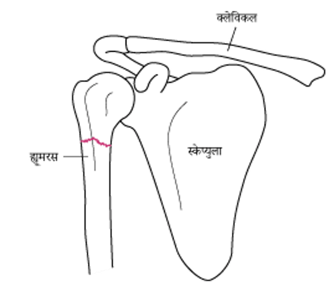 कंधे का फ्रैक्चर