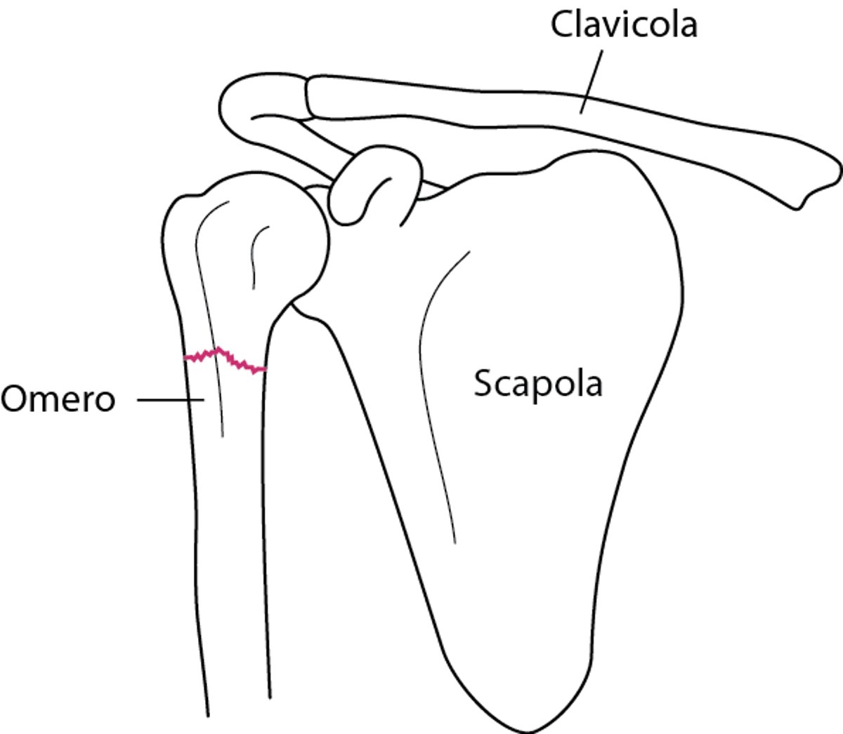 Frattura della spalla