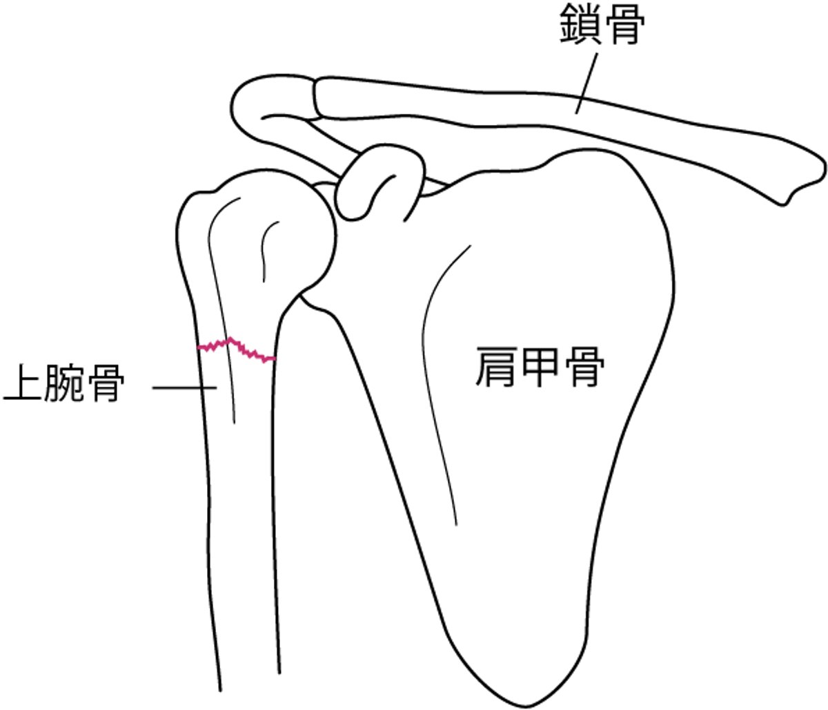 肩かたの骨折こっせつ