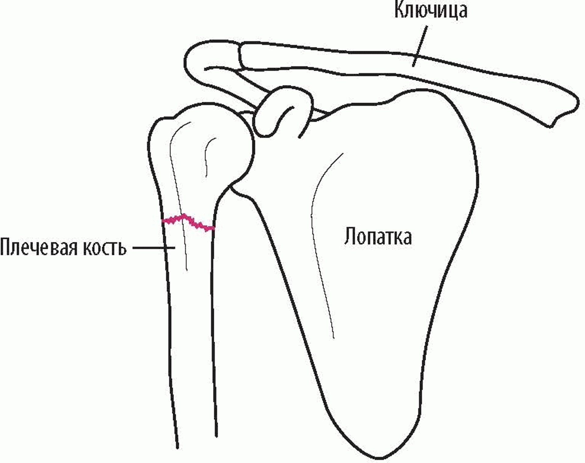 Перелом плеча