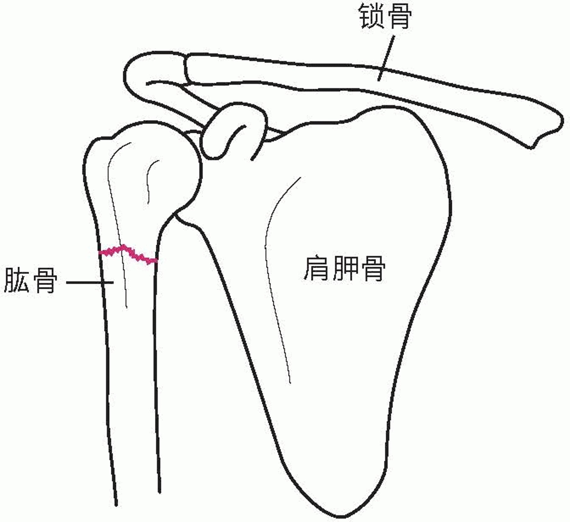 肩部骨折