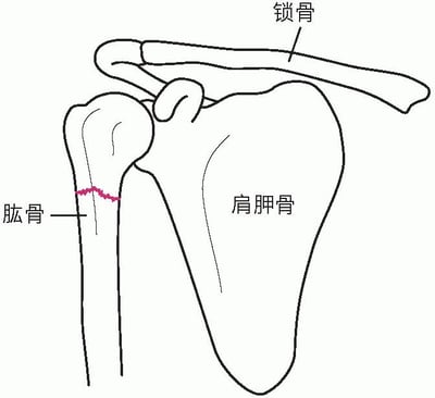 肩部骨折