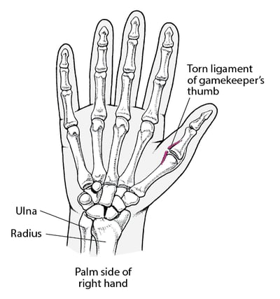 Spraining the Thumb: Gamekeeper's Thumb