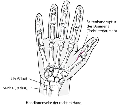 Verstauchung des Daumens: Torhüterdaumen