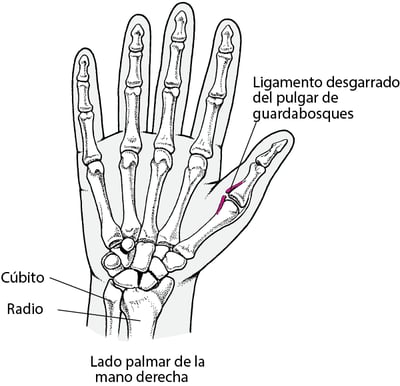 Esguince del pulgar: pulgar de guardabosques o pulgar de esquiador