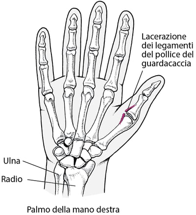 Distorsione del pollice: il pollice del guardacaccia