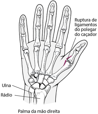 Entorse do dedo polegar: polegar do caçador