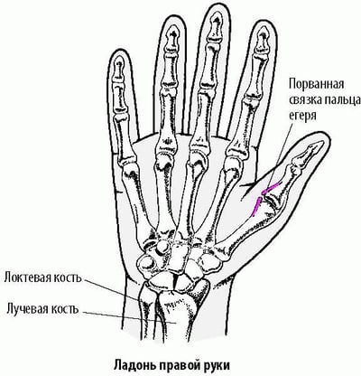 Растяжения большого пальца: Палец егеря