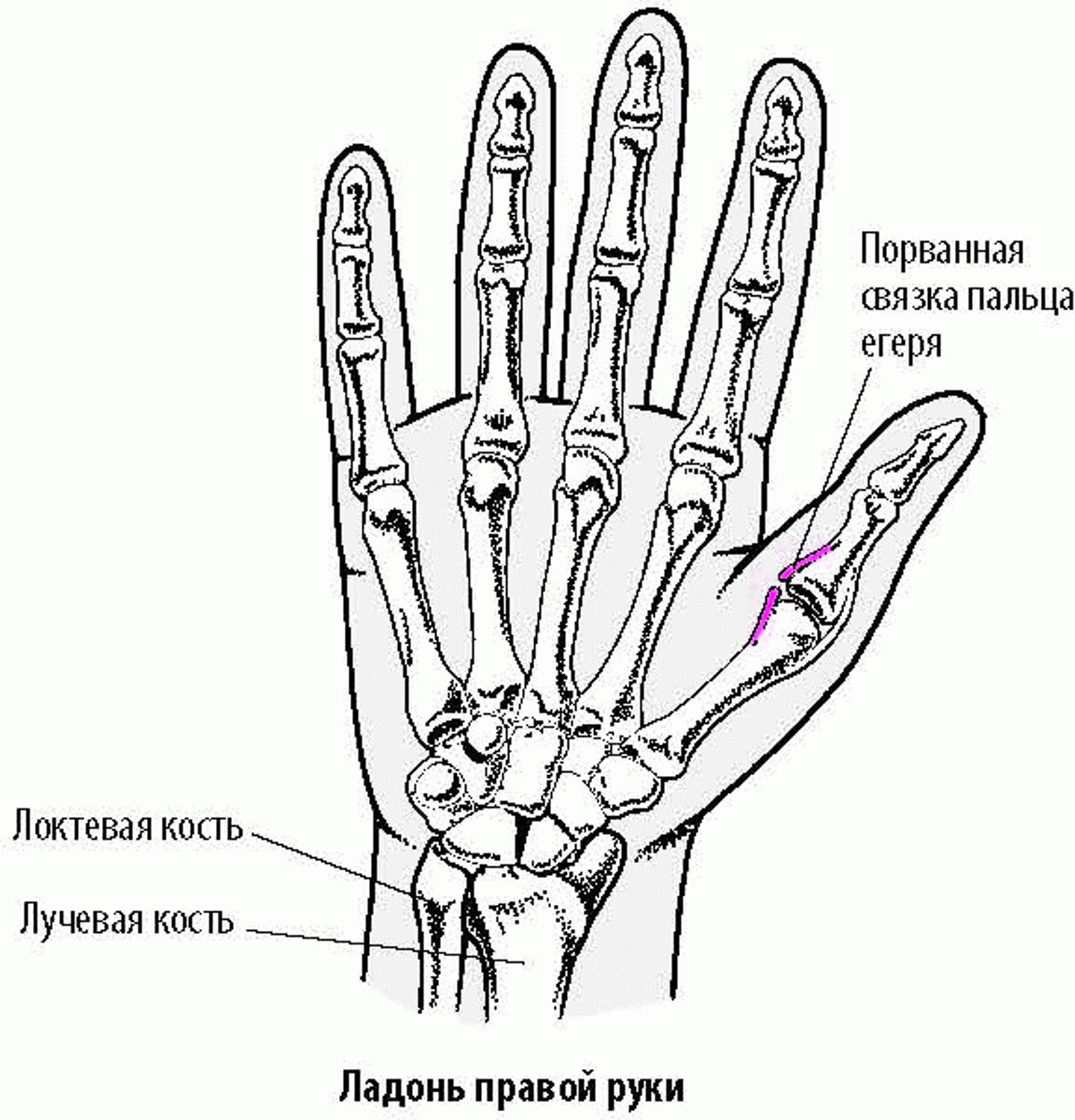 Растяжения большого пальца: Палец егеря