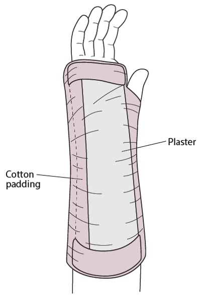 الجبيرة الراحية Volar splint