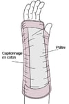 Attelle palmaire