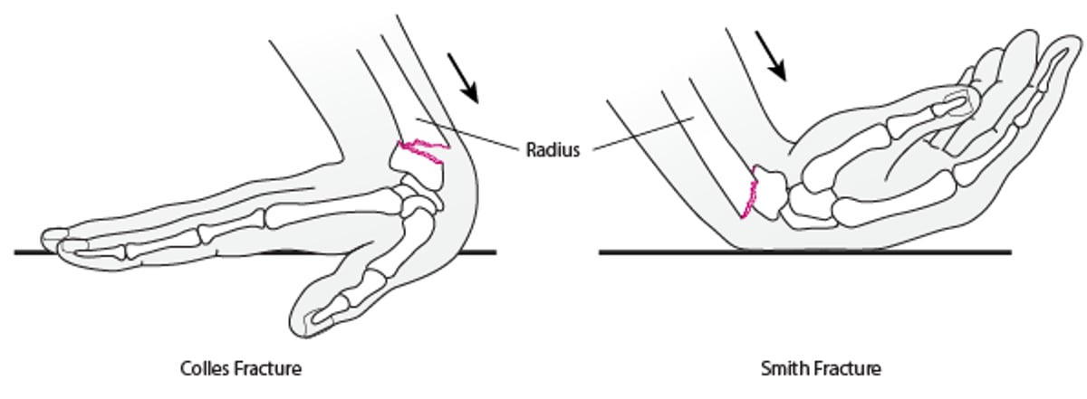 Wrist Fractures