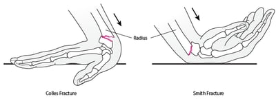 Wrist Fractures