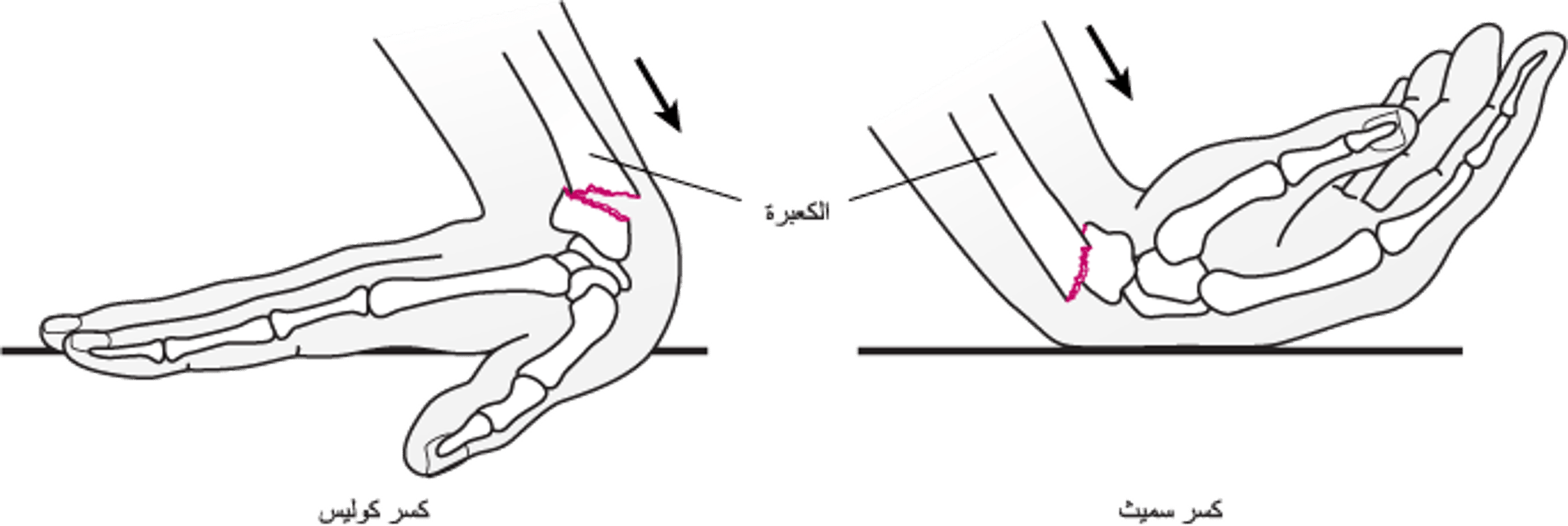 كسورُ المعصم