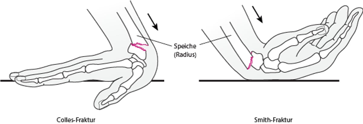 Handgelenksfrakturen