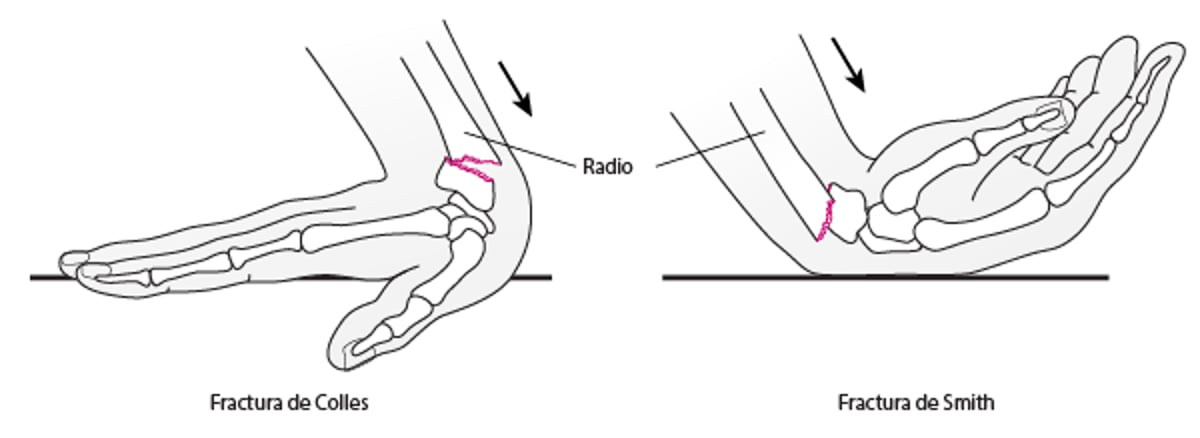 Fracturas de la muñeca