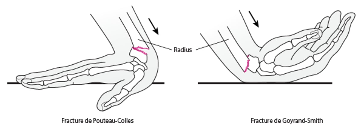 Fractures du poignet