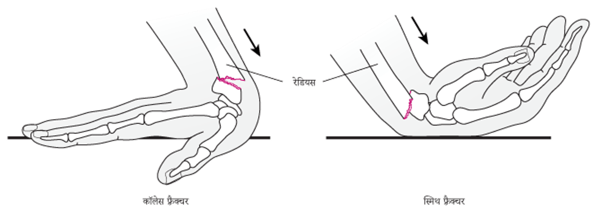 कलाई के फ्रैक्चर