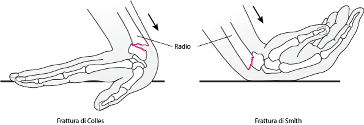 Fratture del polso
