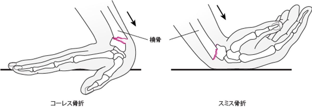 手首てくびの骨折こっせつ
