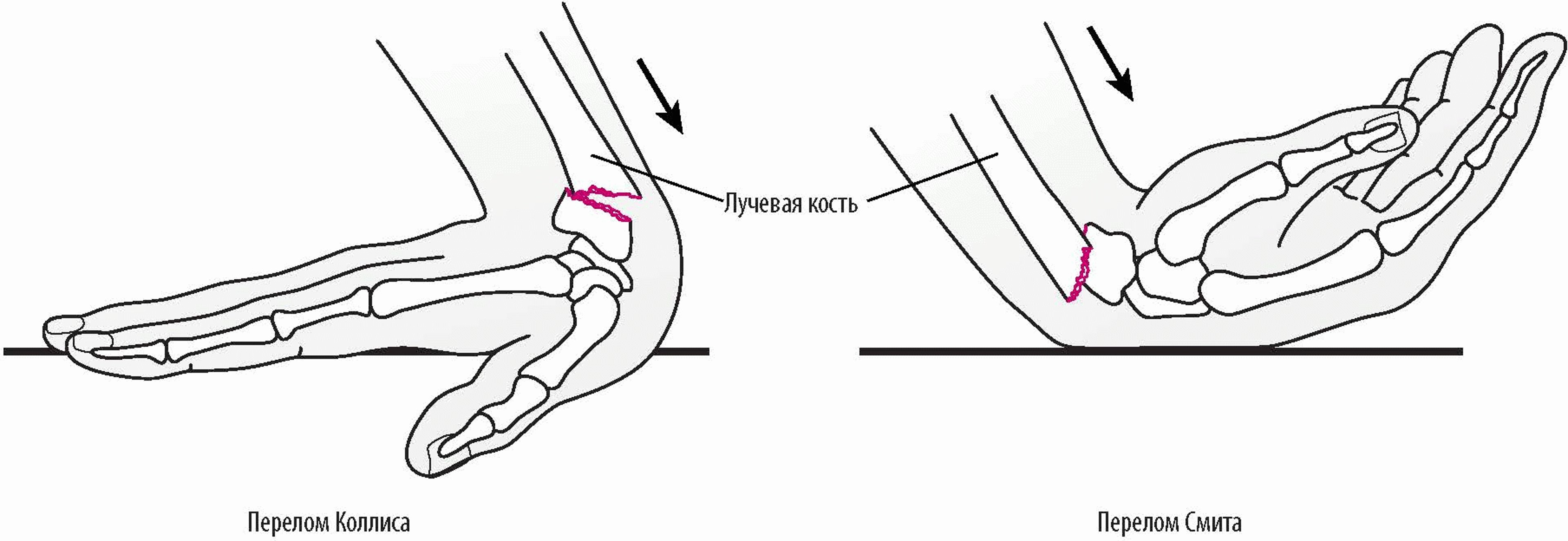 Переломы запястья