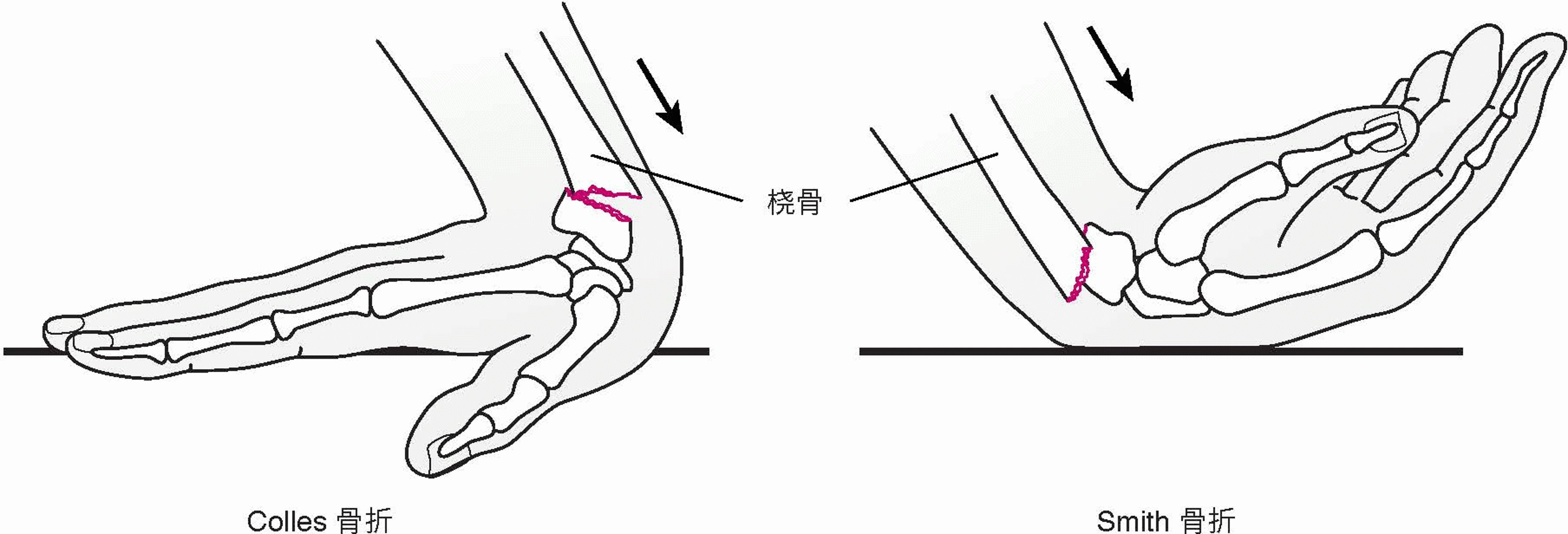 腕部骨折