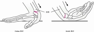 腕部骨折