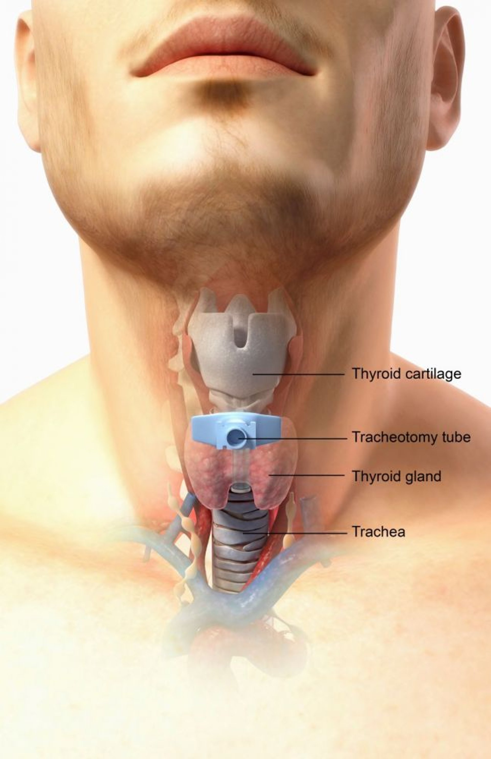 Tracheotomia