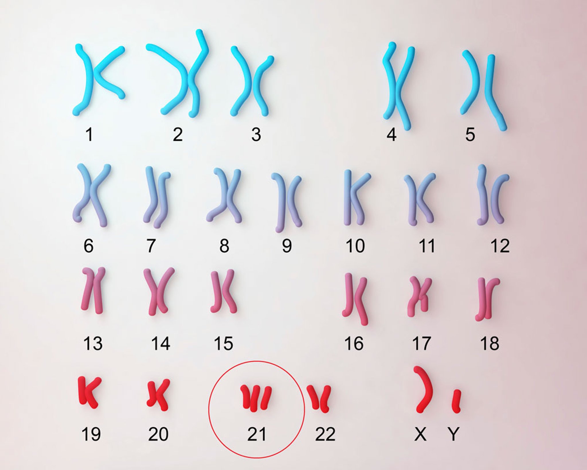 Down Syndrome Karyotype