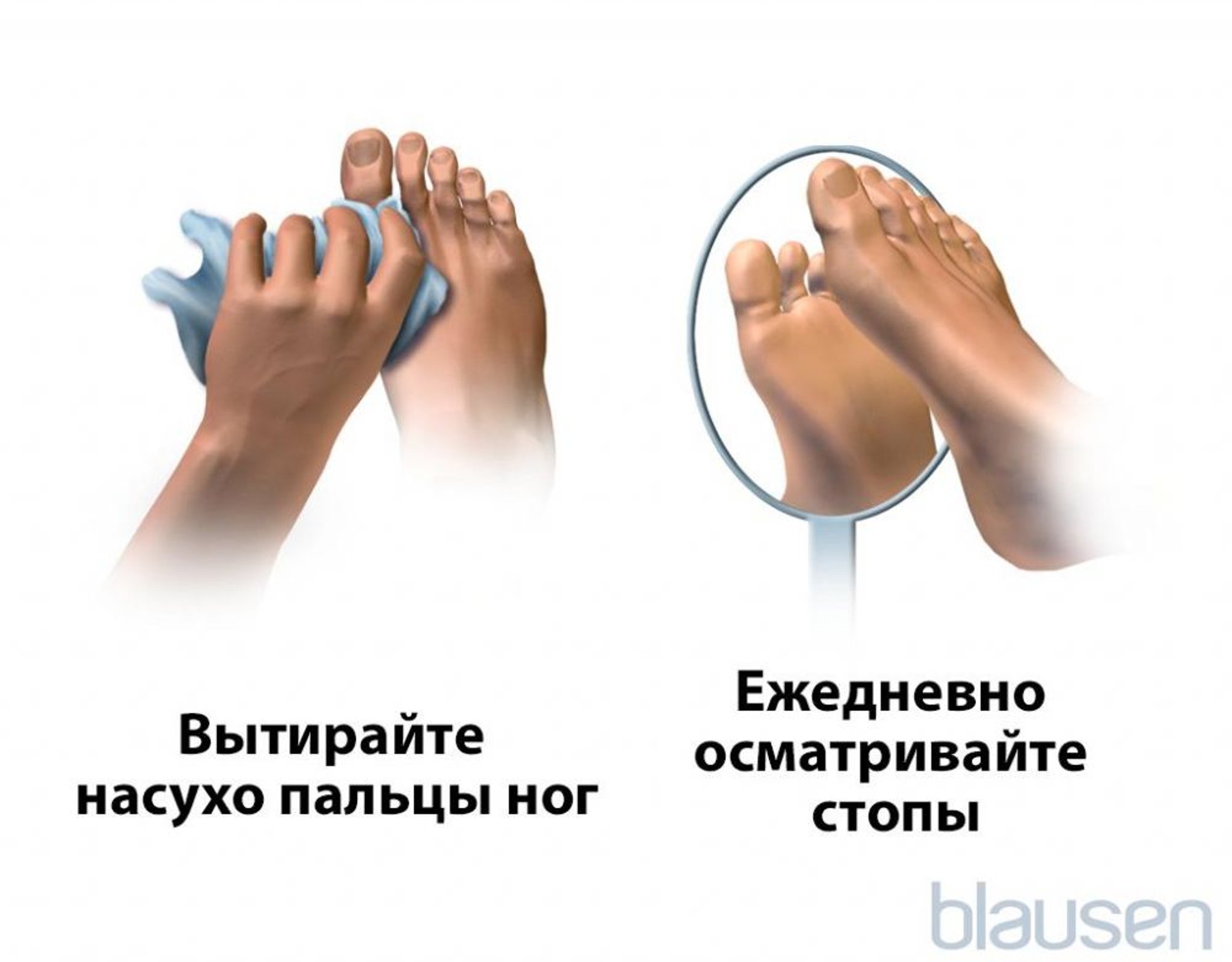 Уход за стопами больных диабетом