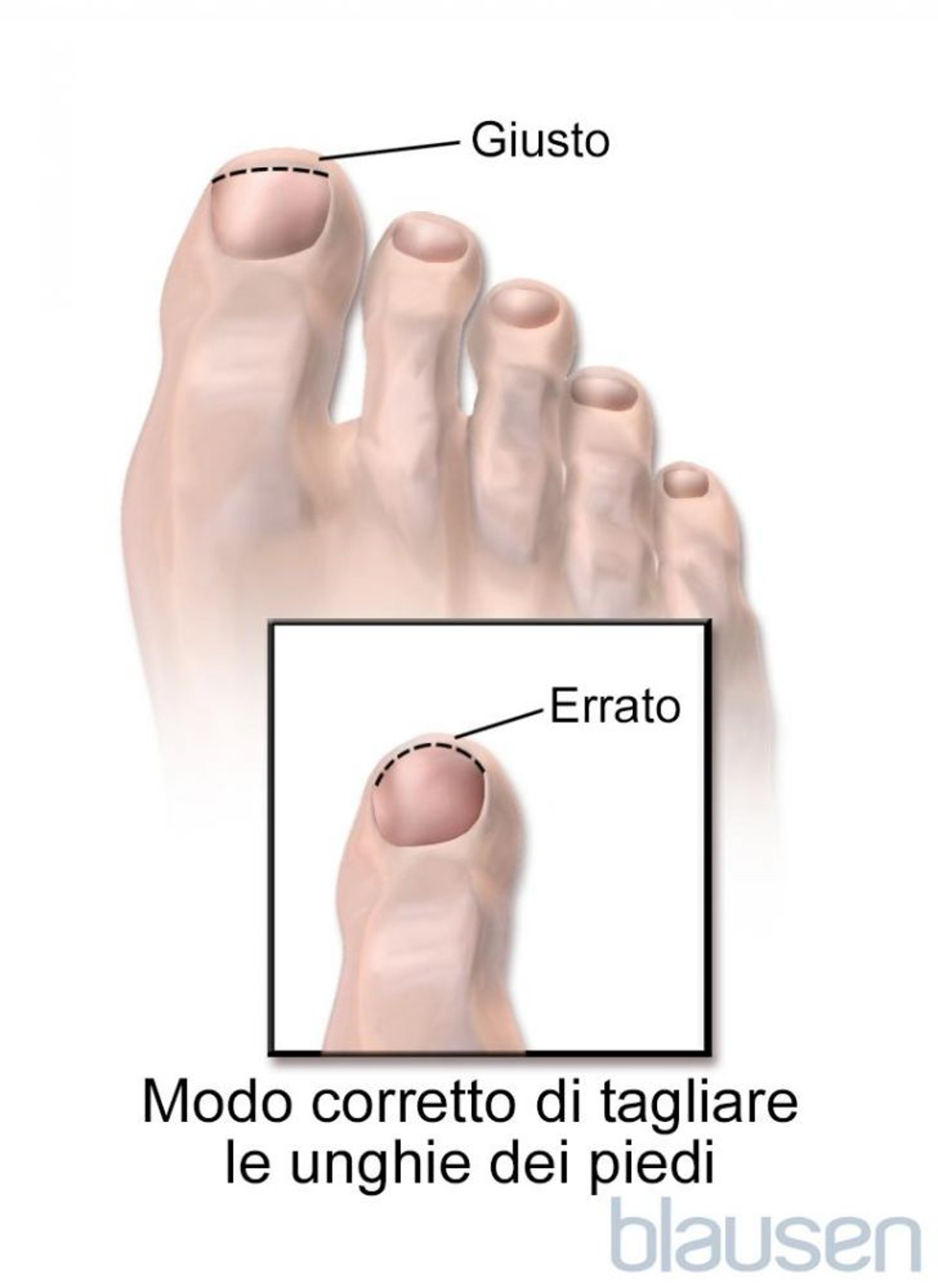 Modo corretto di tagliare le unghie dei piedi