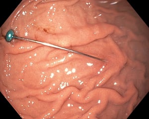 Corpo estraneo appuntito nello stomaco (endoscopia)
