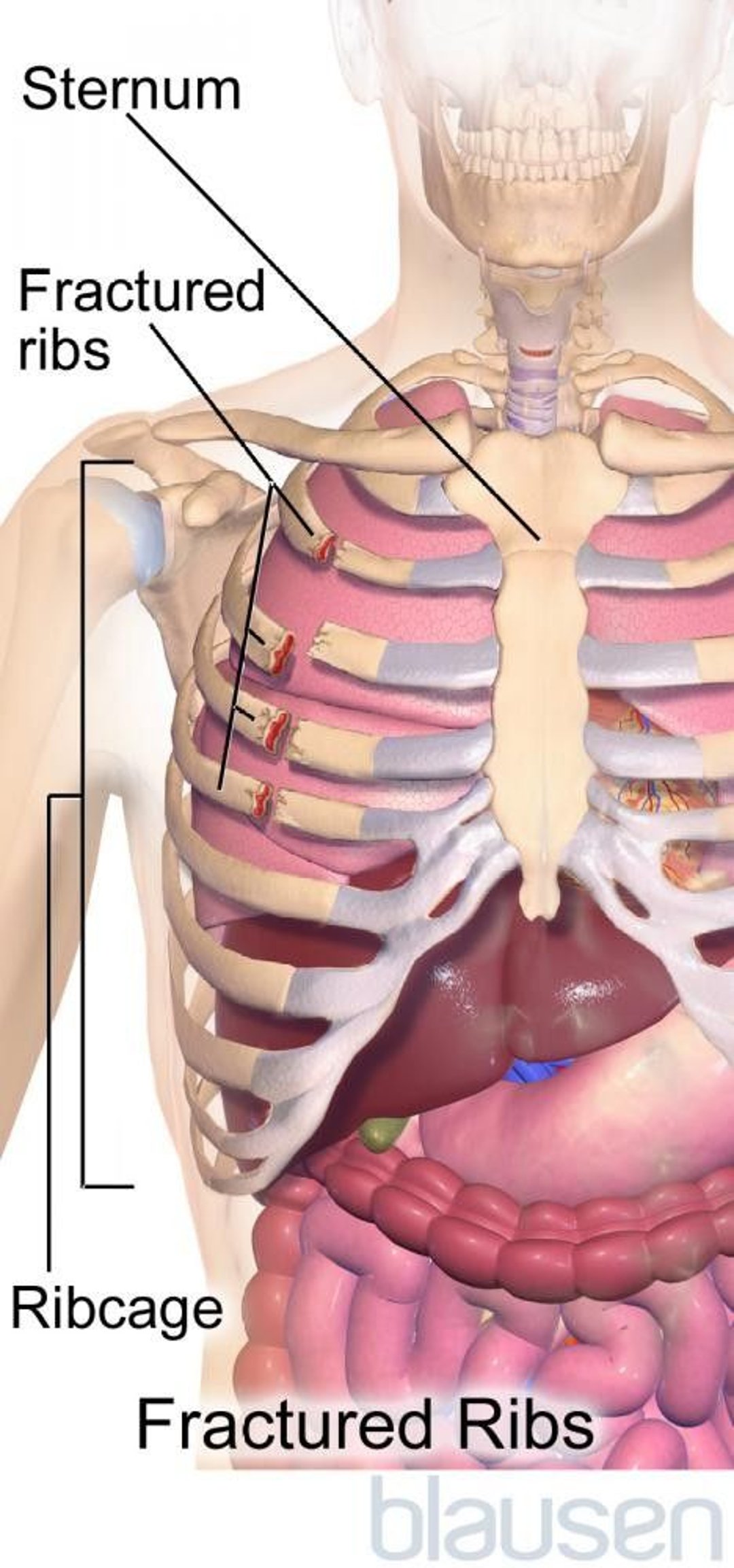 Fractured Ribs